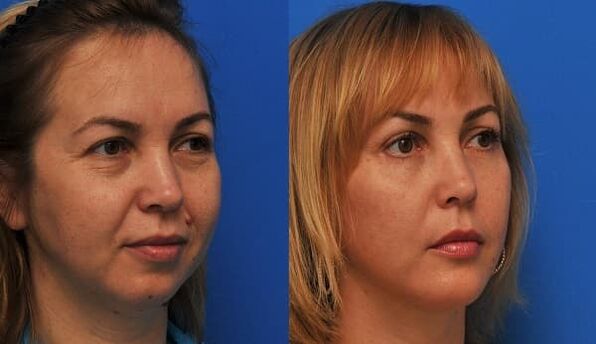 πριν και μετά την αναζωογόνηση του δέρματος με σύσφιξη Φωτογραφία 1