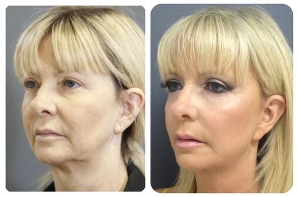 πριν και μετά την αναζωογόνηση του δέρματος με σύσφιξη Φωτογραφία 2