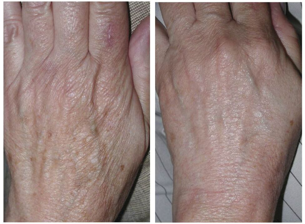 Αναζωογόνηση των χεριών με laser πριν και μετά τις φωτογραφίες