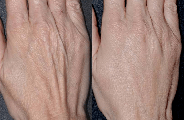 Πλαστικό περίγραμμα, αναζωογόνηση χεριών Photo 2 πριν και μετά