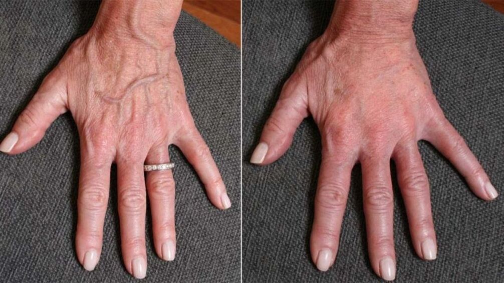 Πλαστικό περίγραμμα, αναζωογόνηση χεριών Φωτογραφία 1 πριν και μετά